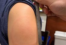 Μπράτσο-Covid: Σπάνια παρενέργεια του εμβολίου της Moderna