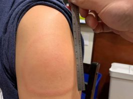 Μπράτσο-Covid: Σπάνια παρενέργεια του εμβολίου της Moderna