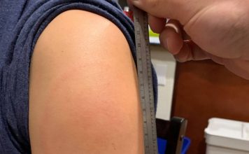 Μπράτσο-Covid: Σπάνια παρενέργεια του εμβολίου της Moderna