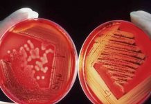 Ο λόγος που ο Candida Auris τρομάζει πολύ περισσότερο απ’ τον κορωνοϊό