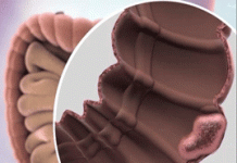 Φάρμακο “εξαφάνισε” τον καρκίνο του παχέος εντέρου