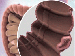 Φάρμακο “εξαφάνισε” τον καρκίνο του παχέος εντέρου