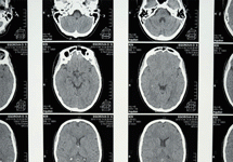Μεγαλύτερος ο κίνδυνος της επιληψίας μετά από νόσηση με κορονοϊό παρά μετά από γρίπη