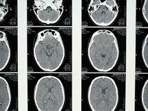 Μεγαλύτερος ο κίνδυνος της επιληψίας μετά από νόσηση με κορονοϊό παρά μετά από γρίπη