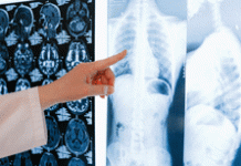 Ανακαλύφθηκε πρωτεΐνη που μπλοκάρει τη λοίμωξη κορονοϊού στους πνεύμονες