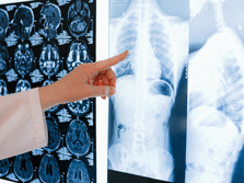 Ανακαλύφθηκε πρωτεΐνη που μπλοκάρει τη λοίμωξη κορονοϊού στους πνεύμονες